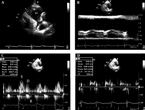 A, The coronary sinus seen from the parasternal right ventricular inflow tract view and B, the measurement of the diameter of the coronary sinus using adjust M-mode ultrasonography; C, the Doppler spectrum of coronary blood flow in the coronary sinus obtained from the parasternal right ventricular inflow tract view and the measurement of Doppler parameters of the coronary sinus flow by digitized Doppler spectral envelops in normal subjects and D, patients with coronary artery disease. RA, right atrium; RV, right ventricle; CS, coronary sinus; S, systolic wave of the antegrade blood flow; D, diastolic wave of the antegrade blood flow; R, retrograde blood flow; Env. Ti, duration of measured envelope
