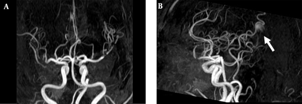 3D TOF MRA of the AVM shown in Figure 1. A, Coronal; B, Sagittal views show no AVM nidus can be identified due to lack of venous phase information. A high signal intensity (arrow) resulting from flow artifacts of the great cerebral vein might be misdiagnosed as a vascular lesion.