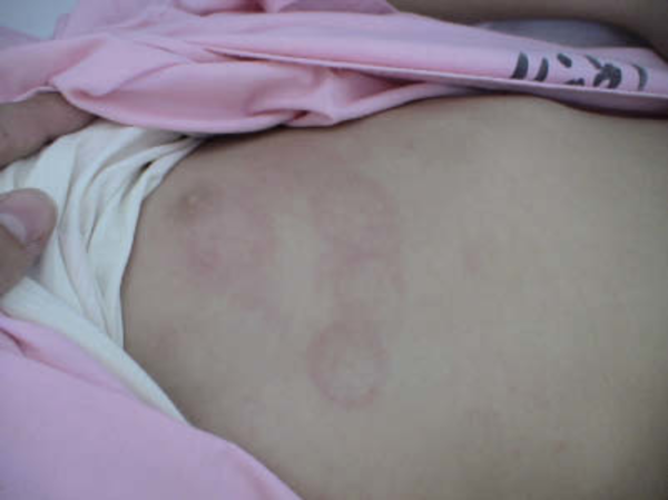 Cutaneous Rash in Seven Years Old Girl With Fever and Hypocomplementemia