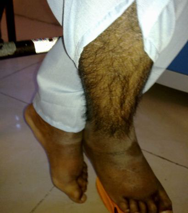 Hypertrichosis and Hyperpigmentation of Lower Extremity Skin
