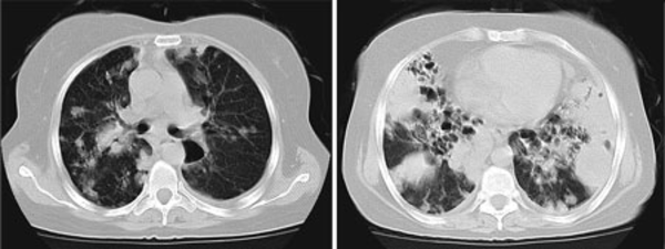 Computed Chest Tomography of Patient on Arrival Revealed Multiple Nodules and Discrete Alveolar Infiltration and Bronchiectasis.