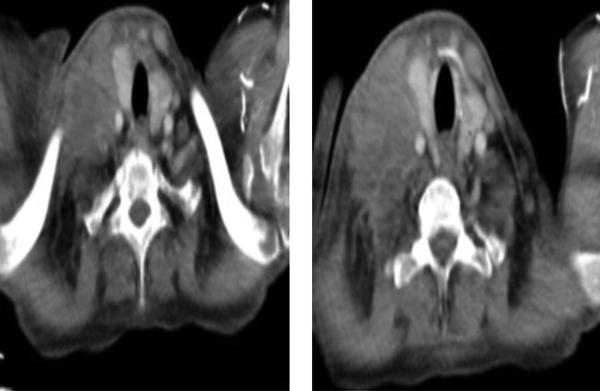 Computerized Tomography Scans of the Patient with Lung Squamous Cell Carcinoma Metastasizing to Right Supraclavicular Fossa