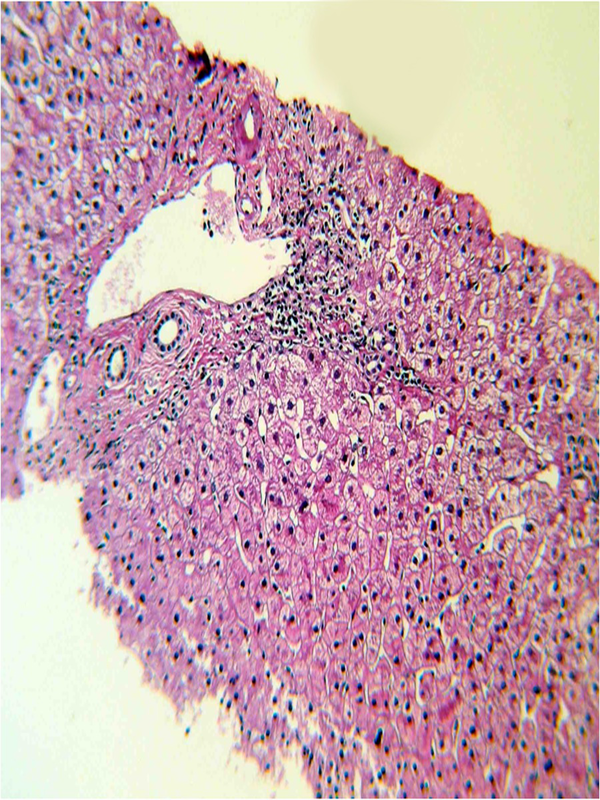 Liver biopsy showing portal spaces with mild mononuclear portal inflammation