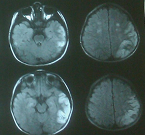 Brain Magnetic Resonance Imaging (FLAIR Sequence)