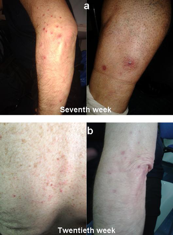A) Localized Exanthematous Pustolosis, With Pruritus at Seventh Week; B) Pustular Lesions at the Back and Upper Limbs, Involving Less Than 50 % of Body Surface Area at Twentieth Week