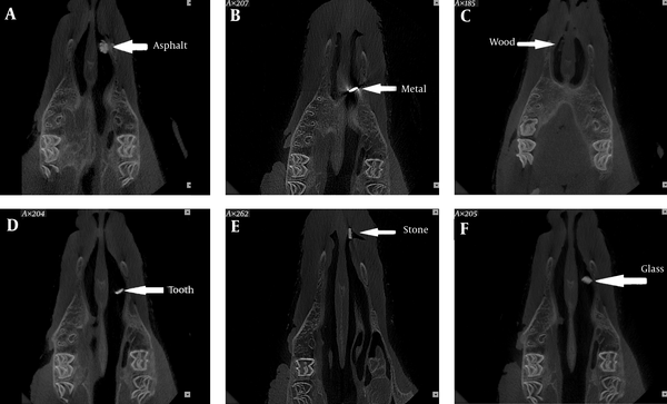 Cone beam computed tomography (CBCT) scans of the foreign bodies in the nose. A, Asphalt; B, Metal; C, Wood; D, Tooth; E, Stone; F, Glass