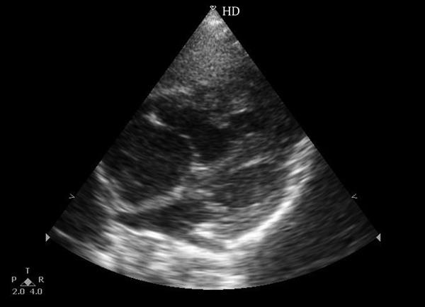 Echocardiography sub Costal View Shows Large Right Atrium and Right Ventricle With Intact Ventricular and Atrial Septum