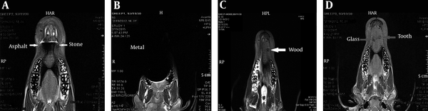 MRI of the foreign bodies in the tongue. A, Asphalt and stone; B, Metal; C, Wood; D, Glass and tooth