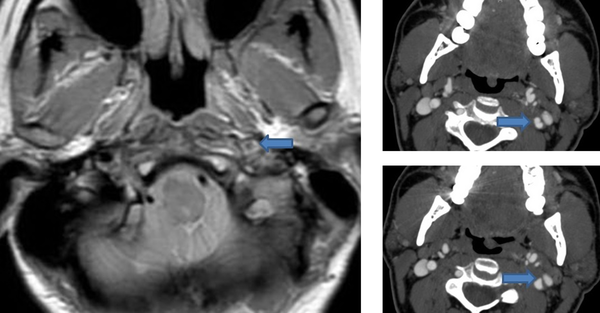 Left: MRI with fat saturation showing an increased signal and luminal narrowing of the left internal carotid consistent with an intramural hematoma due to dissection. Right: Upper image shows the double lumen sign in the left internal carotid artery suggestive of dissection. Lower image shows a small outpunching in the internal carotid artery consistent with a pseudoaneurysm.