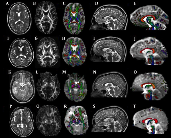 Figure showing the normal distribution of gray and white matter on T2-weighted images of the brain parenchyma (a), an FA map (b), a color coded FA map overlaid on MD (c), mid-sagittal T2-weighted (d) images, and a mid-sagittal color coded FA map overlaid on MD (e). Axial T2-weighted images from patients in Group A (f-j), Group B (k-o), and Group C (p-t) showing hyperintense lesions in the left frontal region (f), right temporal region (k), and right fronto-temporal region (p), respectively. A decrease in FA values is evident in all three patient groups on the corresponding axial FA (g, l, q) and a color-coded FA map overlaid on MD (h, m, r). The corpus callosum (CC) appears normal in a mid-sagittal T2-weighted image of all three groups (i, n, s); however, the sagittal color-coded FA map (j, o, t) shows decreased FA values in the CC in all three patient groups.
