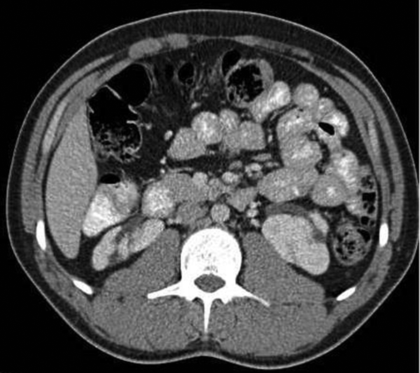 Axial contrast enhanced CT images on the level of lower supernumerary kidneys with marked rotation anomaly