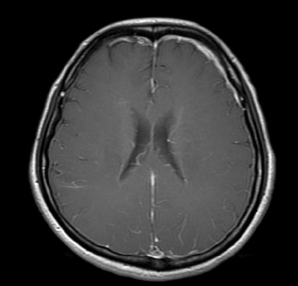 Pachymeningeal enhancement at the bilateral cerebral convexity with more irregular dural thickening at the left frontal convexity is demonstrated. This enhancement is due to small, thin-walled dilated blood vessels in the subdural zone