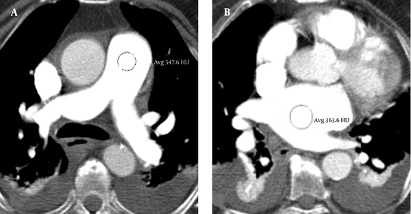 Split-bolus single-pass  64-slice CT shows consistent enhancement in the target pulmonary vessels. The attenuation values in the pulmonary artery trunk (A) and right atrium (B) were higher than 250 HU.