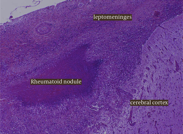 Histology From The Meningeal Biopsy Highlighting The Presence of Giant Cells, Necrotising Granulomas and Palisaded Histiocytes All Consistent With an Underlying an Inflammatory Pach-Meningitis and Leptomeningeal Rheumatoid Nodules