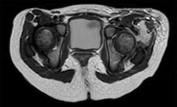 MRI Axial T2 Sequence Showing Periarticular Abscess and Extensive Affectation of Musculature and Subcutaneous Tissue