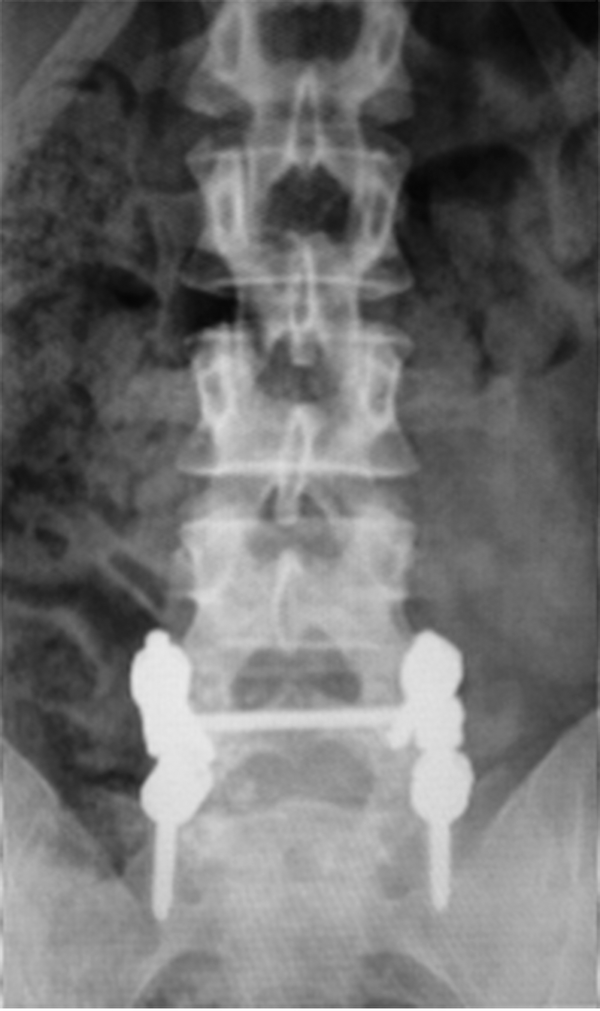 Posterior Radiographic View of L5-S1 Lumbar Arthrodesis
