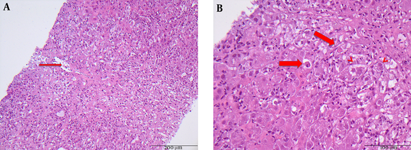 A, Severe hepatitis with bridging necrosis is demonstrated. Arrow indicates central vein (original magnification × 200); B, Arrows indicate apoptotic bodies. Arrow heads indicate hepatocytes with severe cell swelling (original magnification × 400).