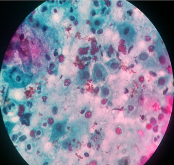 Entire smear showing hyperchromasia (nuclei darker than those of intermediate cells, cells are enlarged with slight increase in nucleus/cell ratio, with no prominent nucleoli (hematoxylin and eosin, ×40).