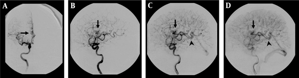 DSA examination of the AVM shown in Figure 1. A, Corresponding anteroposterior projection of injection into the right internal carotid artery, showing an AVM nidus (arrow) supplied by a branch of the right anterior cerebral artery; B, Early; and C, Late arterial; D, Venous phase lateral projections show the AVM nidus (arrow) and deep venous drainage occurs via an internal cerebral vein (arrow head) in the straight sinus.