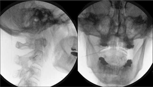 Lateral View With a 5º Oblique Tilt for Initial Needle Entry (Left). Postero-Anterior View (Right) of Needle Entry into Lateral C1/2 Joint. Notice the Active Tip Does Not Contact the Intra-Articular Osseous Surface.