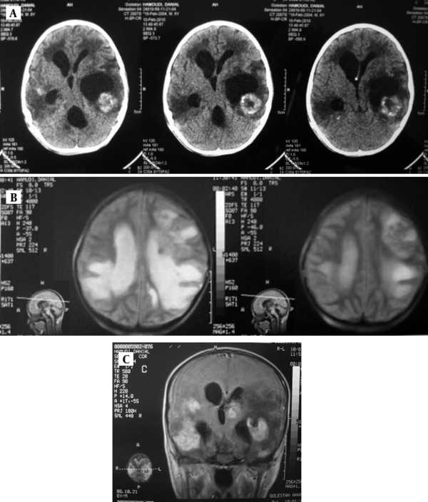 A: T1- Weighted axial MRI: Hyperdense lesions with surrounding vasogenic edema. B: T2-Weighted axial MRI: Intermediate signals with bright signal vasogenic edema. C: MRI with contrast: Multiple enhancing lesions.