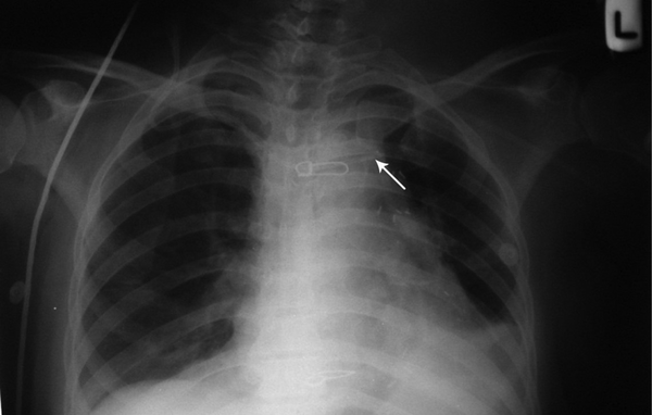 Central venous catheter is inserted through a right subclavian approach. Misplacement can be seen in the brachiocephalic vein.