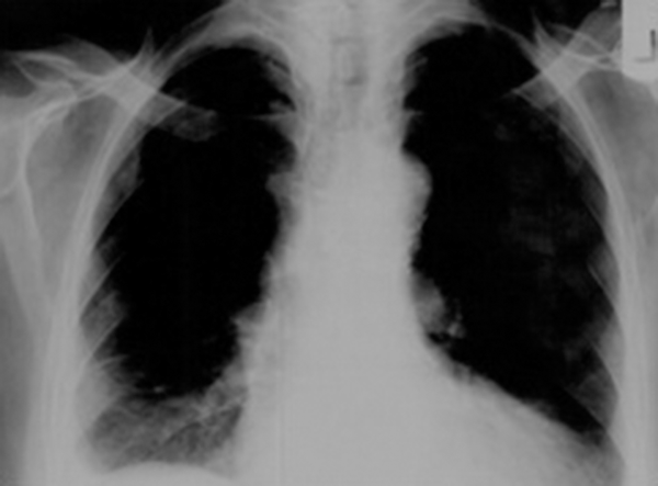 CXR Revealing Massive Pleural Effusion in the Left Side of the Chest