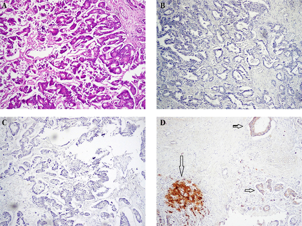 A, Sections Show Metastatic Adenocarcinoma From Colon (H & E x100); B, Arginase Staining Shows Negative Cytoplasm; C, Glypican Shows Negative Cytoplasm; D, A Case of Metastatic Adenocarcinoma of Colon Which Shows Weak Positivity of the Metastatic Glands, Horizontal Arrow (Compare With Intense Staining With the Normal Liver, Vertical Arrow)