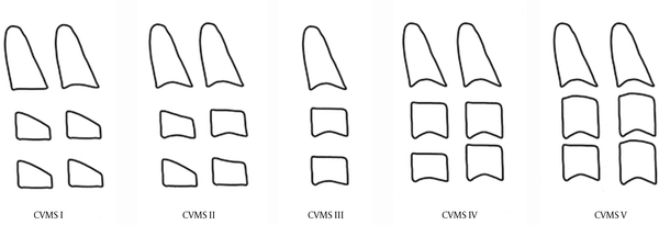 The 5 cervical vertebral maturation stages (CVMS) (Baccetti et al.) (10)