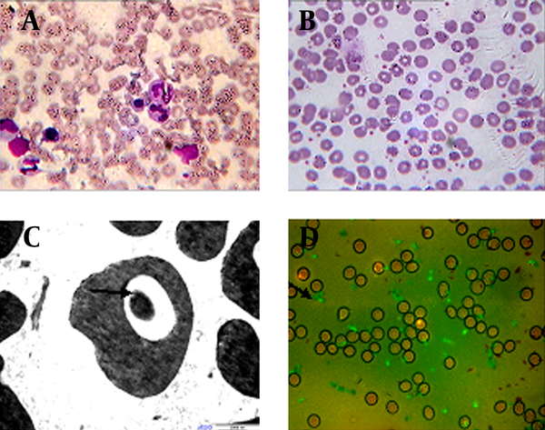 A. Parasites in red blood cells of the patient’s bone marrow (1000×), B. Babesia in the thin blood smear stained with Giemsa (1000×), C. Babesia observed in the blood by TEM (bar = 2 µm), D. Result of Babesia by IFA (1000×).