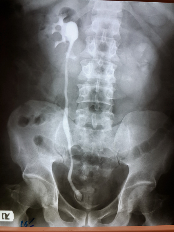 Defect and Severe Hydronephrosis of the Left Kidney Were Demonstrated.