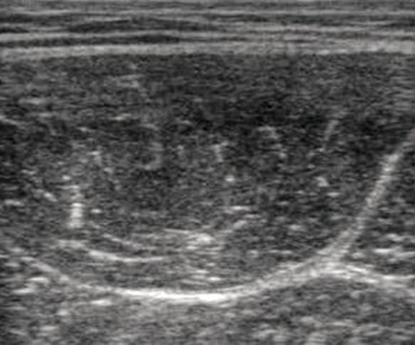 Ultrasonography of the Rectus Femoris Muscle