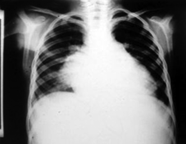 Chest X-Ray Showing Severe Cardiomegaly, Large Left Atrium and Left Ventricle, Prominent Pulmonary Artery Segment and Increased Pulmonary Blood Flow
