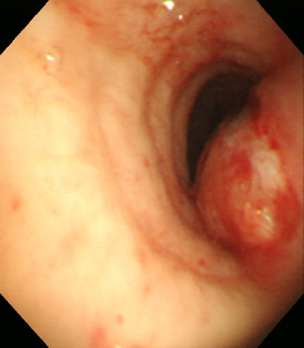 Diagnostic Bronchoscopy Revealing a 5 cm Linear Laceration on the Posterior Membranous Wall