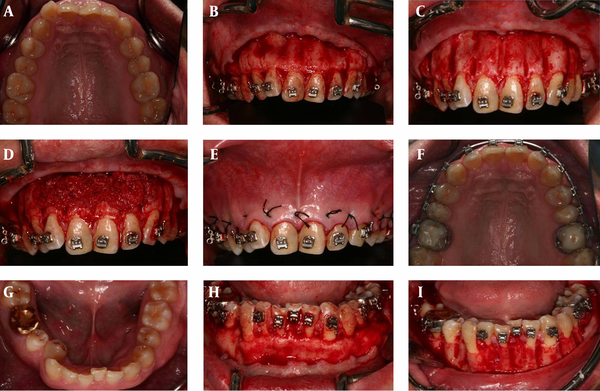 Treatment duration decreased to less than 6 months using this method. A, Pretreatment clinical view of maxilla. B, After flap elevation. C, Grooving of interdental alveolar bone. D, Filling the area with bone graft material. E, Sutures. F, Posttreatment clinical view of maxilla. G, Pretreatment clinical view of mandible. H, After flap elevation. I, Grooving of an interdental alveolar bone. J, Filling the area with bone graft material. K, Sutures. L, Posttreatment clinical view of mandible.