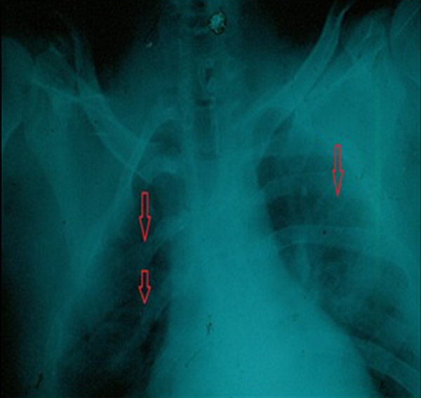 Bifid Rib in Chest X-Ray