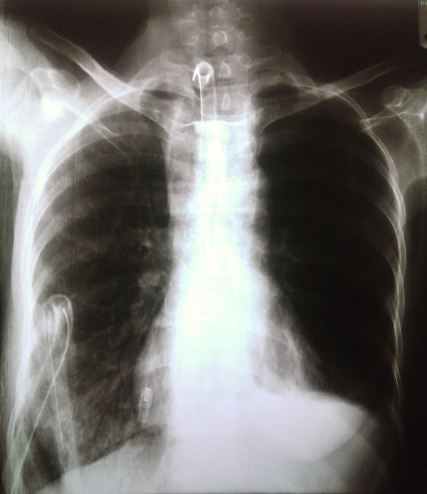Preoperative Chest X-ray