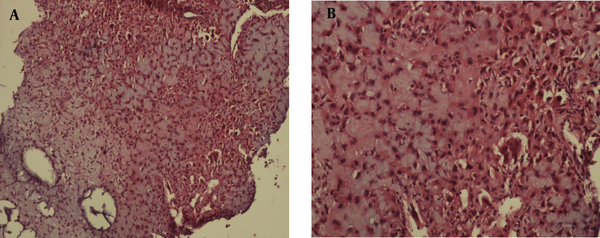 A and B, Histopathological examination shows chondroid tissue admixed with fibroblasts and scanty multinucleated giant cells (H & E staining, Magnification, ×200 and ×400) spinous process of fifth cervical vertebra.
