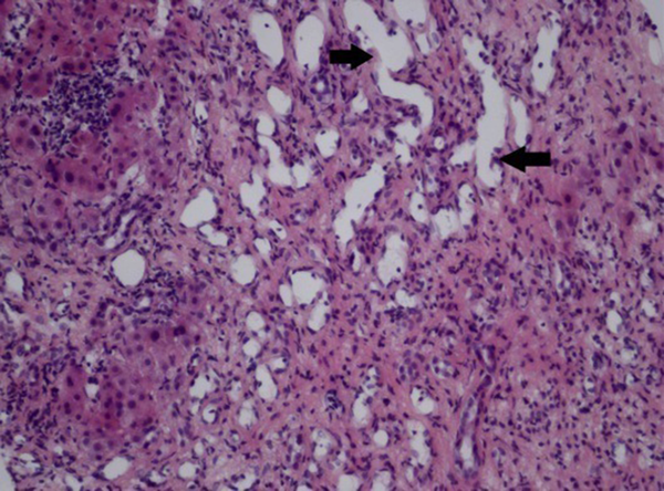 Fibrous tissue and capillary hyperplasia are present, with surrounding hepatic cord atrophy. New vascular structures (black arrow) are shown to be dilated as angiomatous changes (H &amp; E × 200).