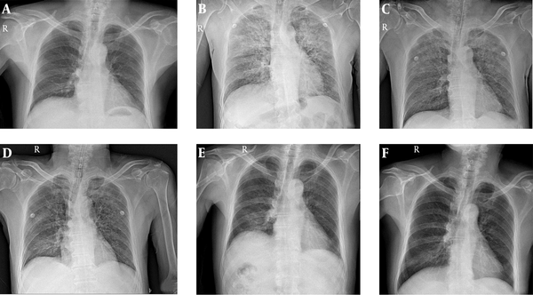 A, Preoperative chest radiograph; B, after development of acute respiratory distress, showing the bilateral peribronchial consolidation; C, postoperative 1 day; D, 2 days, improving the pulmonary infiltrates; E, postoperative 4 days, after weaning mechanical ventilation; F, postoperative 11 days, on discharge.