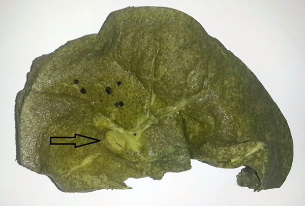 A Section From an Explanted Liver With Primary Sclerosing Cholangitis and Cholangiocarcinoma (arrow) Diagnosed After Liver Transplantation