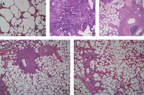 The Influence of PSE on Histopathological Changes in Rats with BLM-induced Lung Injury. A. Normal Lung Histology in the Saline Group; B. Inflammatory Cell Infiltration and Fibrosis in the BLM Group; C. Weaker Fibrosis in the PSE Group (100 mg/kg); D. Reduced Lung Fibrosis in the PSE Group (200 mg/kg); E. Marked Prevention of Fibrosis in the PSE Group (400 mg/kg).