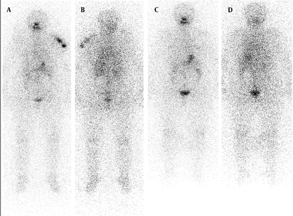 A and B show intense accumulation of I-131 in left humerus mimicking metastatic disease. There was no uptake in thyroid bed demonstrating successful ablation of the remnant. C, Anterior and D, Posterior show that whole-body scan images were normal after having a bath and removing head scarf. There was physiological activity in the bowel and stomach in both scans.