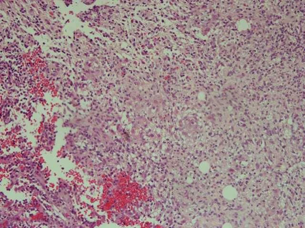 Accumulations of Epithelioid Histiocytes With Langerhans Giant Cells in Dermis