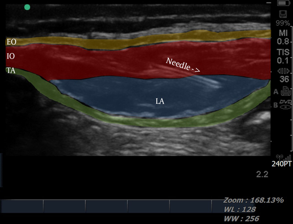 SC: subcutaneous tissue, EOM: external oblique muscle, IOM: internal oblique muscle, TAM: transverse abdominal muscle.