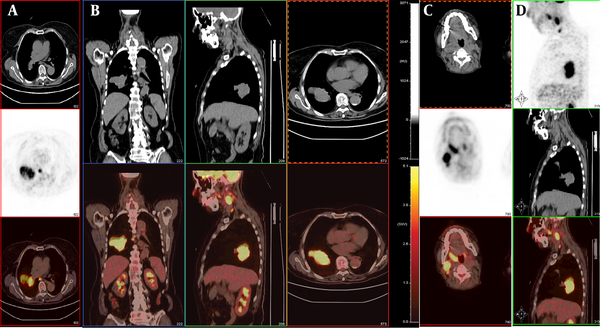 A and B, PET/CT images reveal multiple regions of increased FDG activity in the right lung (SUVmax=11.6) and mediastinal lymph nodes (SUVmax=7.9). C, The images show increased FDG uptake in the right oropharynx (SUVmax=7.3) and multiple intensely 18F-FDG-avid right submaxillary lymph nodes (SUVmax=13.6). D, The image shows increased FDG uptake in the oropharynx