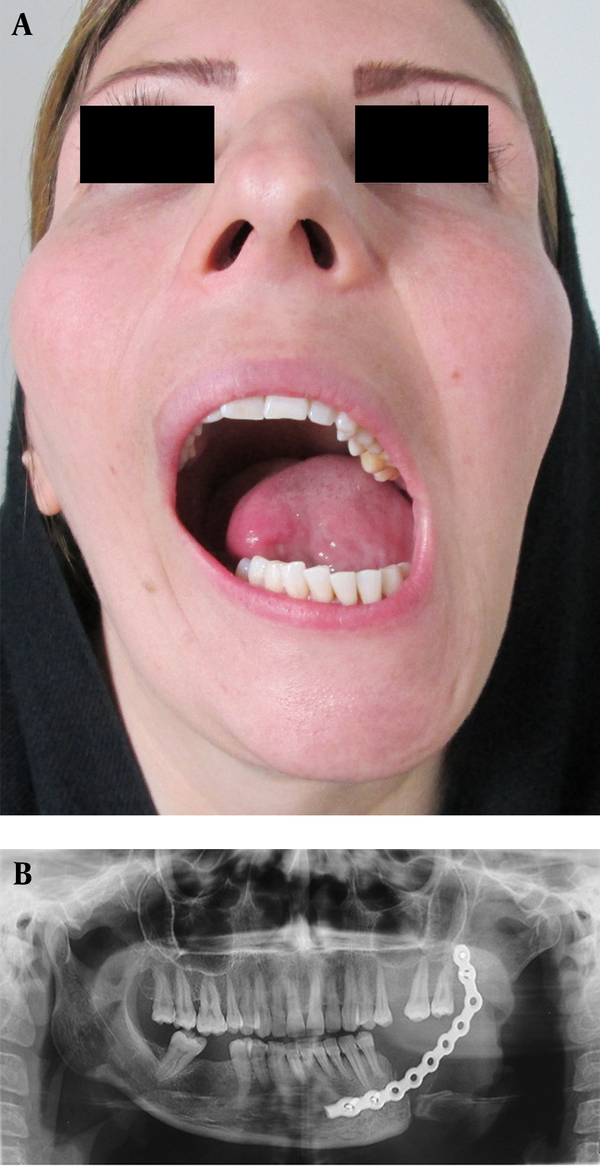 A) Facial asymmetry and mandibular deviation before Ti-Mesh reconstruction; B) Panoramic view: Mal-Positioning of the reconstruction plate.
