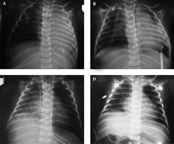 A and B Left Lung Collapse After the Repair of IAA from Midsternotomy Despite Anterior Translocation of RPA. C and D, Postoperative Air Entrapment in the Left Lung of a Patient Who Underwent Surgery for COA and APW Due to a Checked Valve Compressive Mechanism. He Was Managed Only By Chest Physiotherapy Without Anterior Translocation of RPA