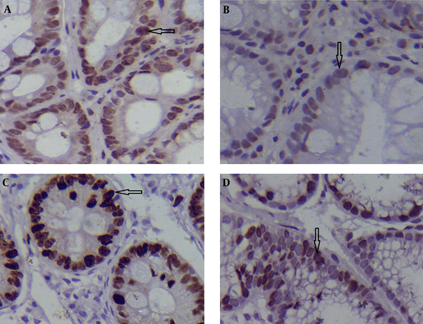 p53 expression in the tissue infected with H. pylori (A) and not infected with H. pylori (B); Ki-67 expression in cases with H. pylori infection (C) and those without H. pylori infection (D) (arrows); magnification × 400.