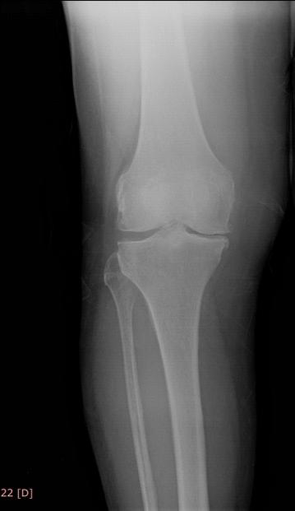 Knee Radiography After Prolotherapy